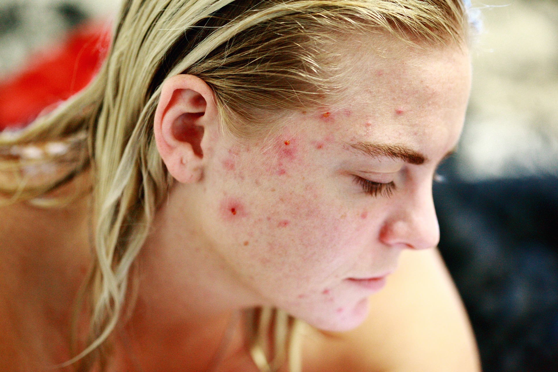 Read more about the article <strong>O que pode causar a acne?</strong>